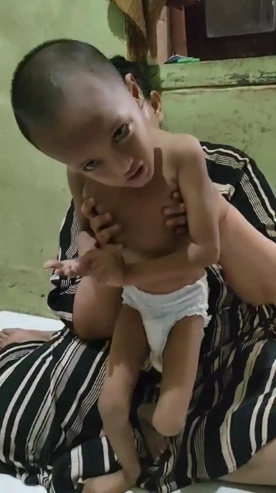 donasi-bertahun-tahun-hidupnya penuh penderitaan! sekujur