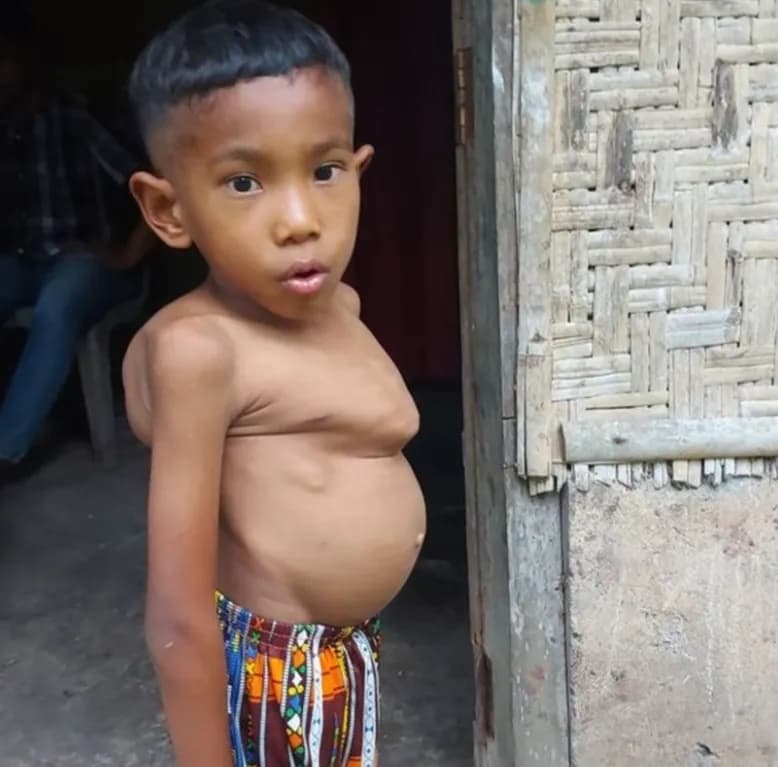 donasi-evan-sering kali menangis kesakitan karena tulangn